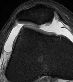 Patella Dislocation Chondral Damage Medial Facet Patella